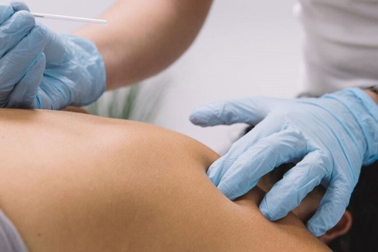 Dry Needling for Muscular Pain Physical Therapy patient for dry needling